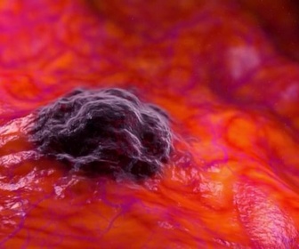 Replay ARTE Journal - Près de 40 % des cancers pourraient être évités